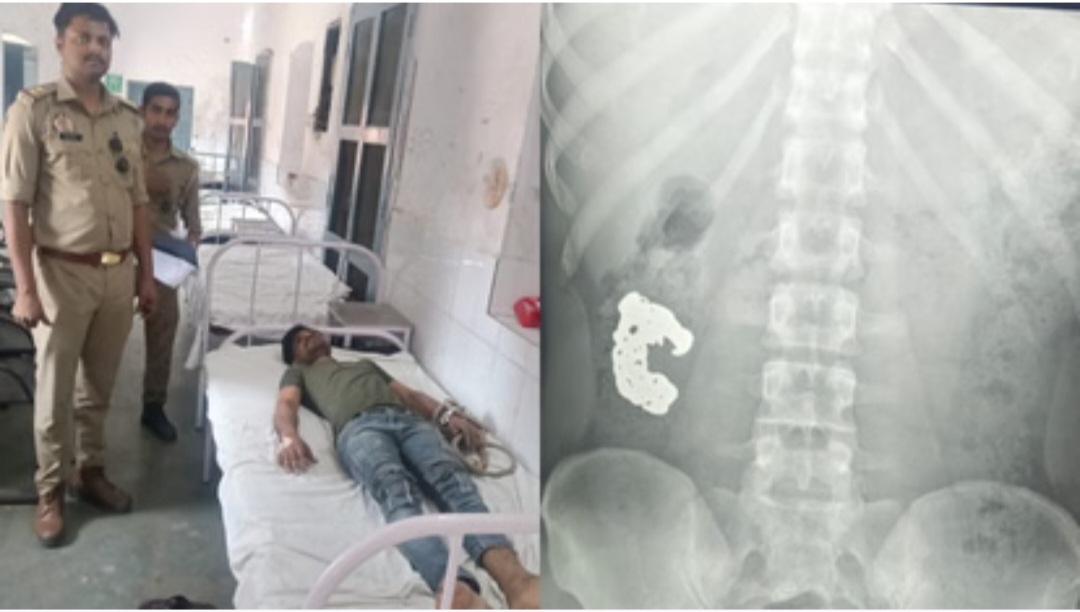 चोर ने निगला चांदी का ब्रेसलेट, पुलिस ने बरामदगी के लिए अपनाया खास तरीका